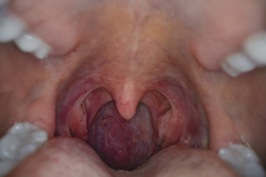 Throat Cancers